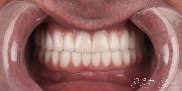 Dental implant