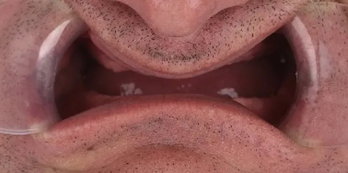 Dental implant