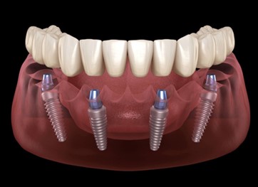 Dental implant